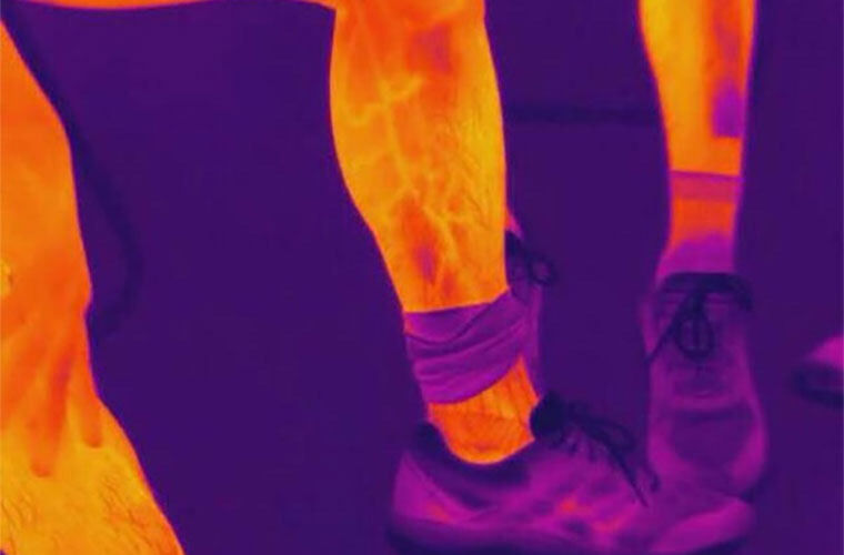 医用红外热像仪是怎样进行疼痛定位的?